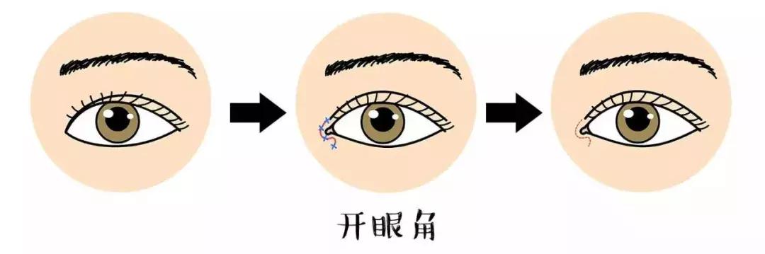 双眼皮眼袋手术揭秘,双眼皮手术时最全攻略