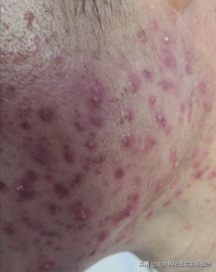 喜辽妥软膏可以祛除红色痘印吗,疤克可以去除脸上的红色痘印吗