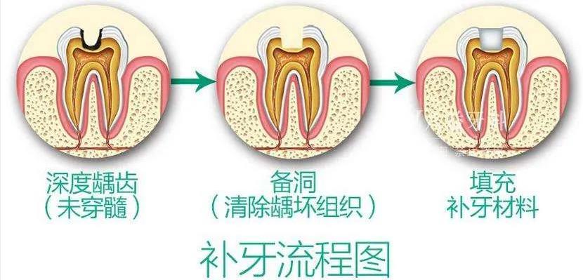 蛀牙不补还可以忍忍,补完牙反而更疼了!被坑坏了