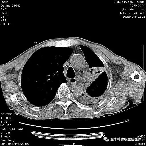 手术引起乳糜胸,有没有做了肺结节手术后是误诊的