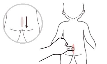 宝宝湿疹反复,中医小儿推拿有什么好方法?