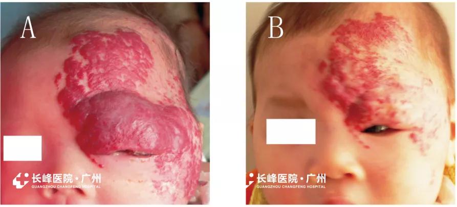 眼部血管瘤会变癌吗,眼睛血管瘤造成失明可以恢复吗