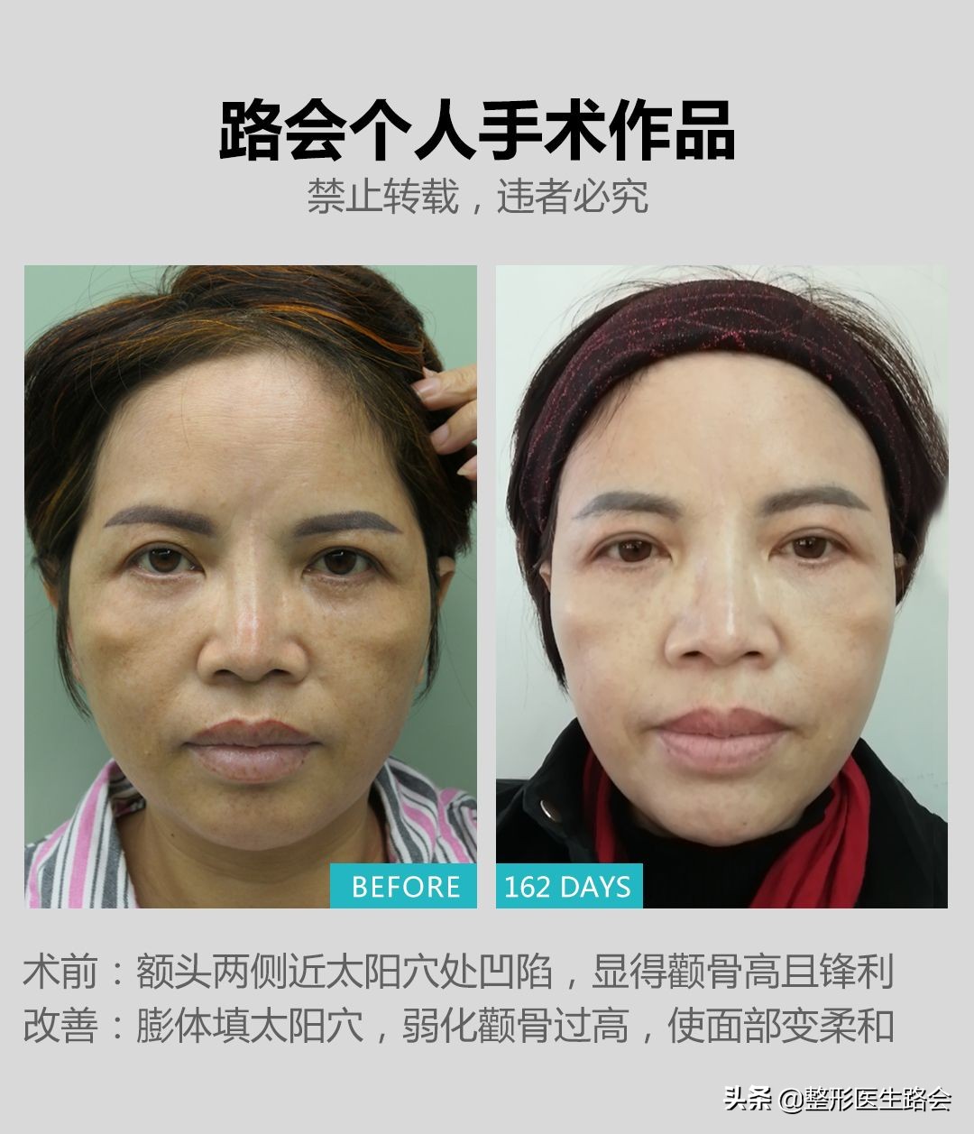 太阳穴凹陷属于额头不饱满吗,太阳穴填充的位置