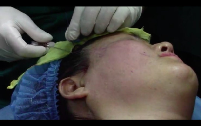 线雕三个月摸起来仍凹凸不平,面部线雕后凹凸不平如何处理