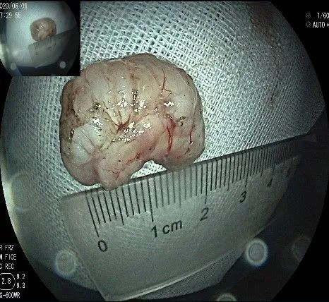 贲门处见隆起性病变,贲门高级别瘤变esd术后不能吃什么