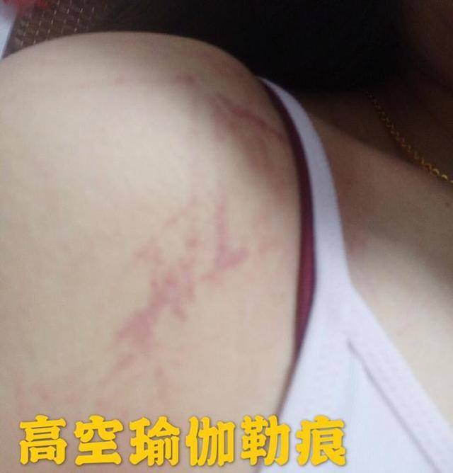 假体隆胸坏死,女子隆胸30年的假体突然破