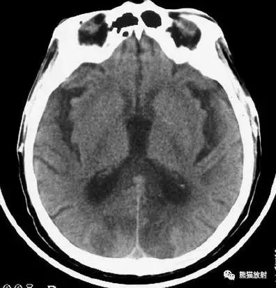 脑梗死丨演变、血供区域分布、CT表现