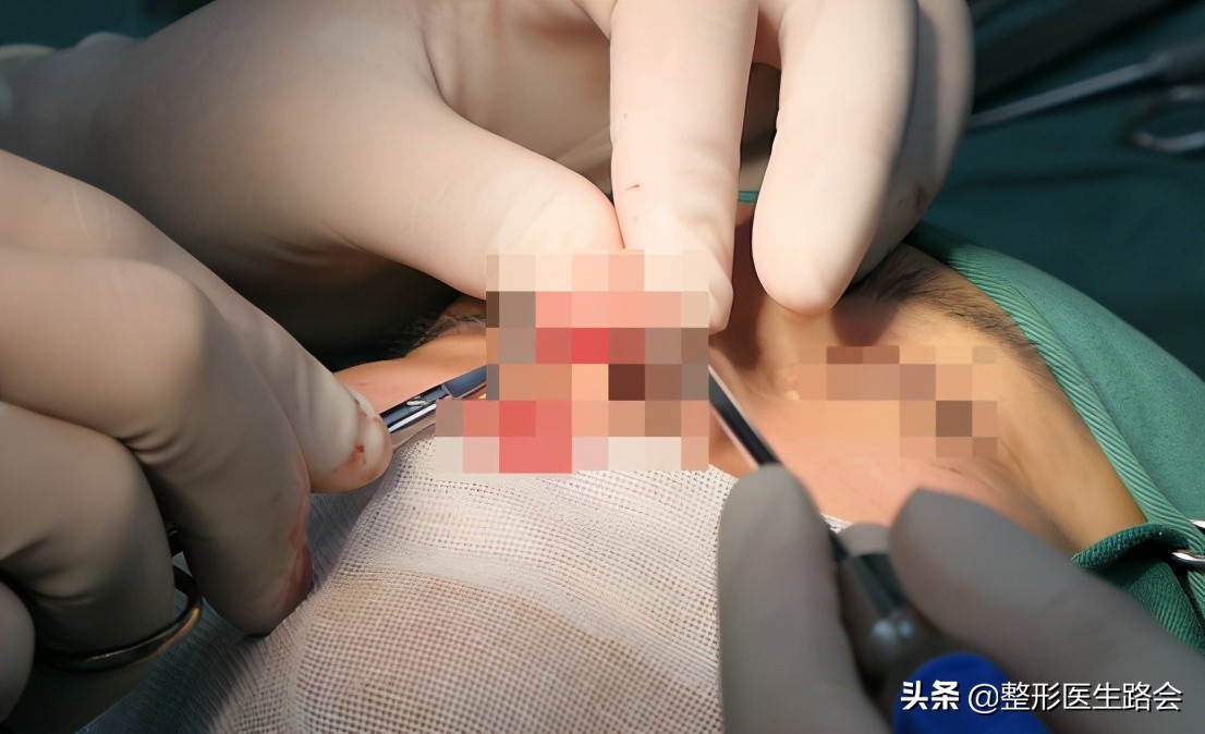 做的耳软骨鼻塌下去了怎么修复啊,做了耳软骨鼻如何不塌