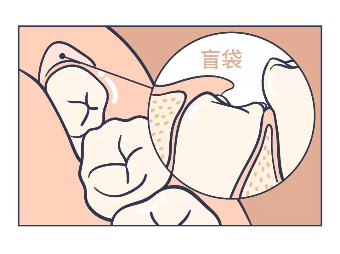 智齿拖着不拔的人有的截骨了,如果有炎症的智齿断根不拔能行吗