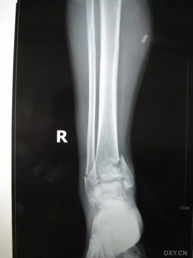 所有骨折都叫什么名字,骨折的名称有哪些