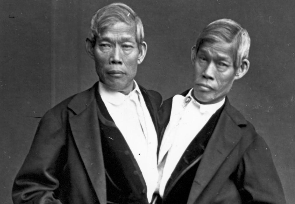 连体人是如何结婚生子呢,连体人结婚生了孩子是什么样子