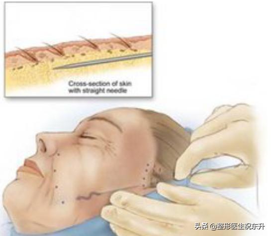 全脸线雕做完即刻提升效果不明显,做完线雕即刻效果不明显
