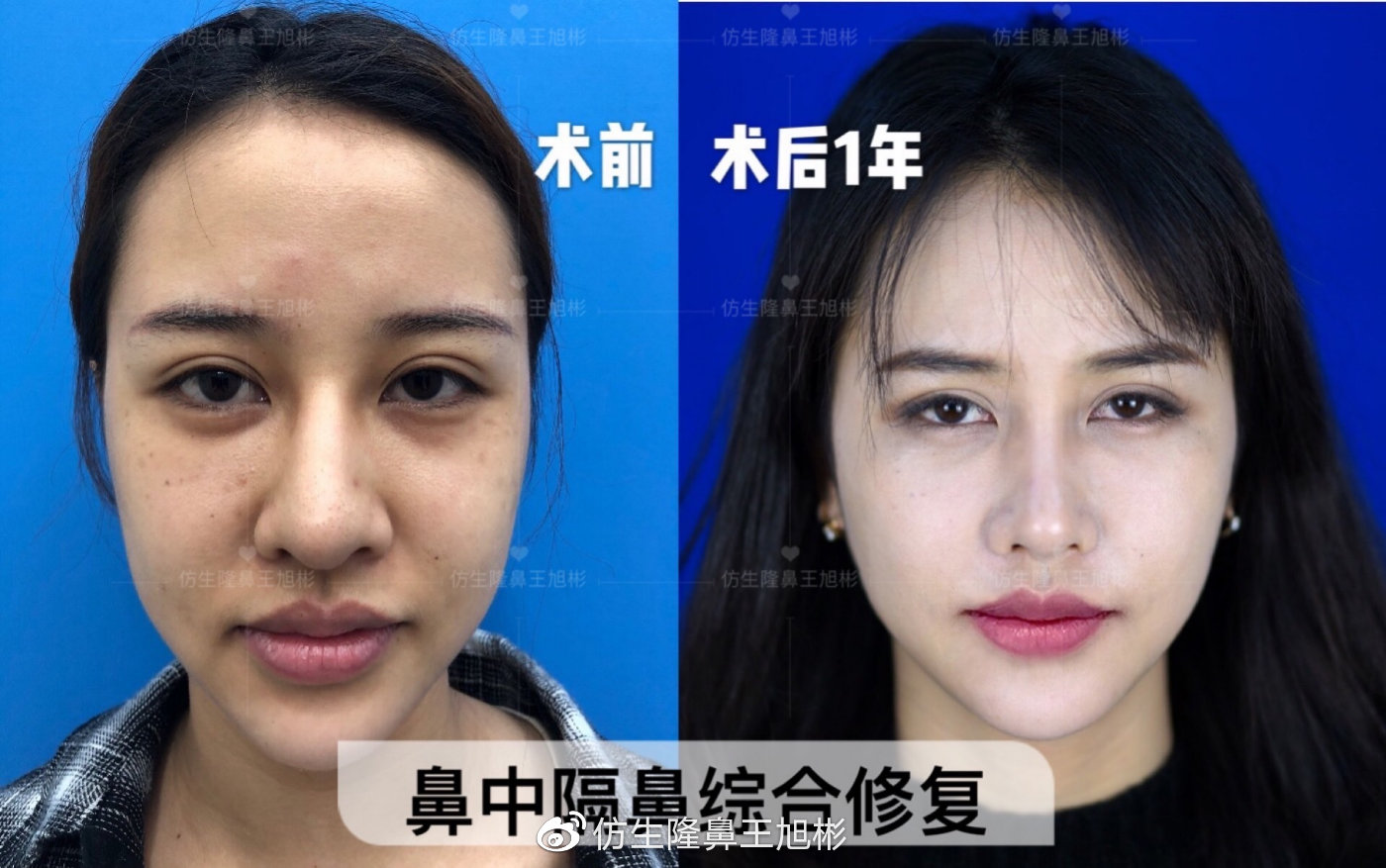 天生鼻小柱歪斜有必要修复吗,天生鼻子歪做肋骨鼻可以矫正吗