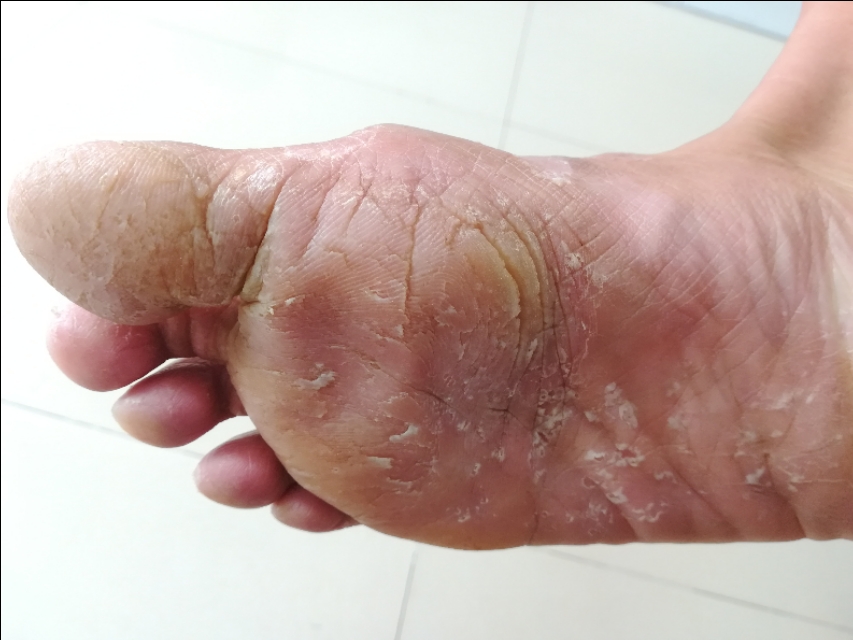 干燥敏感皮肤夏天怎么护理,夏天脸部皮肤脱皮干燥怎么办