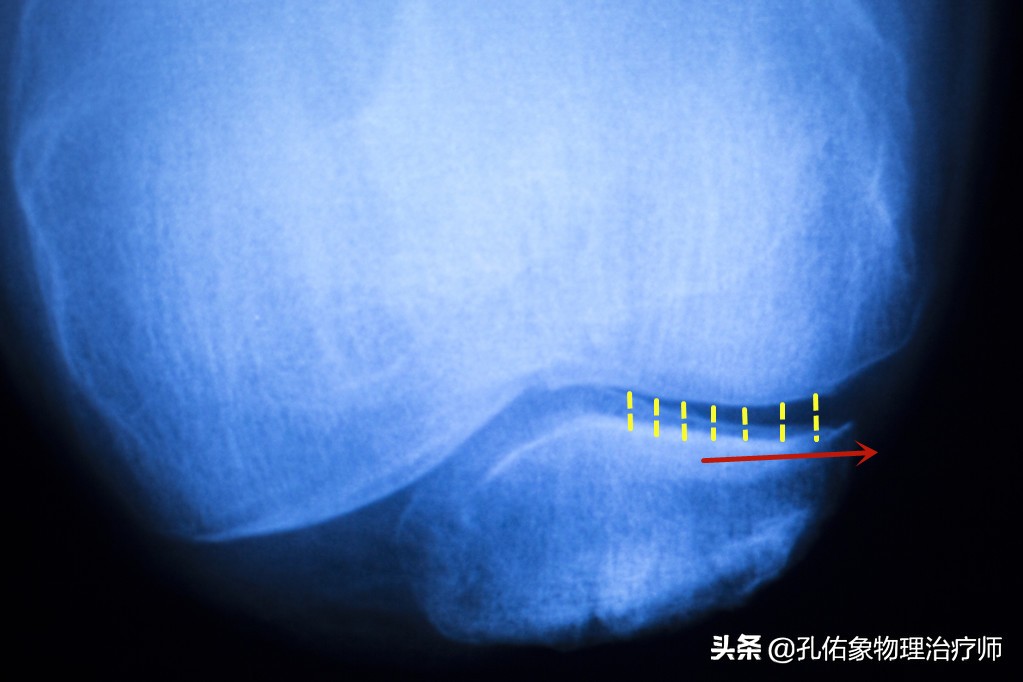 膝盖上下楼梯痛的治疗方法,直腿抬高膝关节弹响疼痛怎么治疗