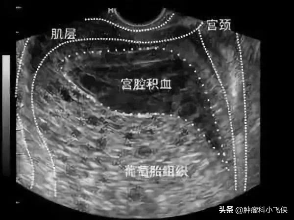 孕早期子宫异常增大伴阴道出血，医生提示小心葡萄胎可能