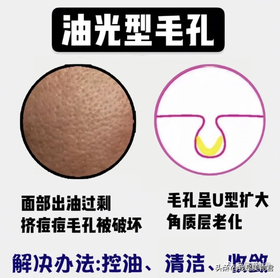 脸上毛孔粗大是什么原因引起的,脸上红血丝毛孔粗大是什么原因