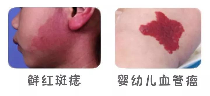 宝宝身上突然长了类似胎记,婴儿身上长的灰色胎记是怎么回事