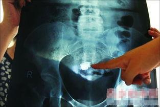 女子纱布入腹死亡,这样的悲剧完全可以避免,来看外科医生的分析