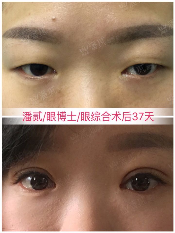 欧式大双眼皮和平行双眼皮,醒醒吧明智的放弃胜过盲目的执着