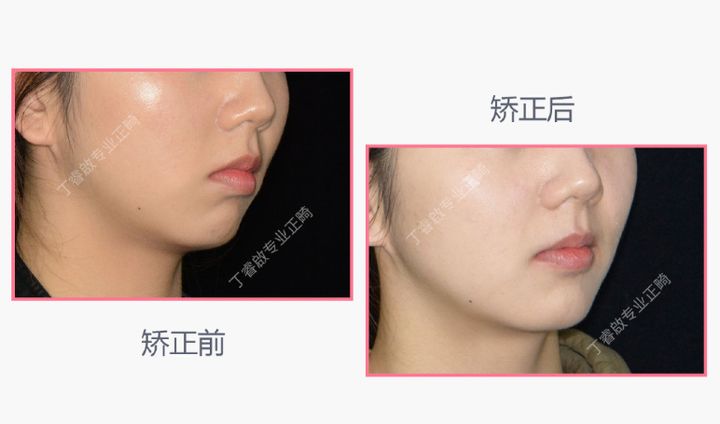 单颗牙隐形矫正,郑州隐形矫正牙齿哪家便宜