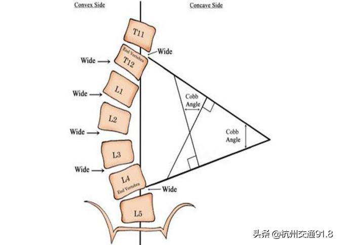 孩子为何斜着身子走路?原来是脊柱有问题