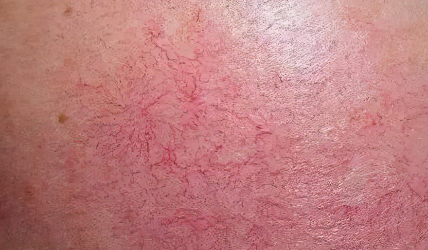 目前治疗红血丝最有效的方法,怎么样治疗红血丝的方法最有效