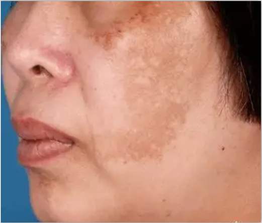 去除脸上的褐斑生活妙招,褐斑去除最有效的办法