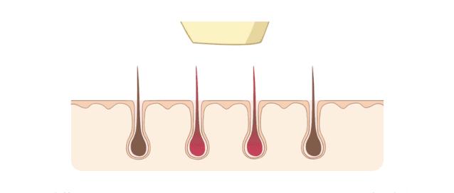 别再傻傻用传统脱毛膏了,激光脱毛和脱毛膏