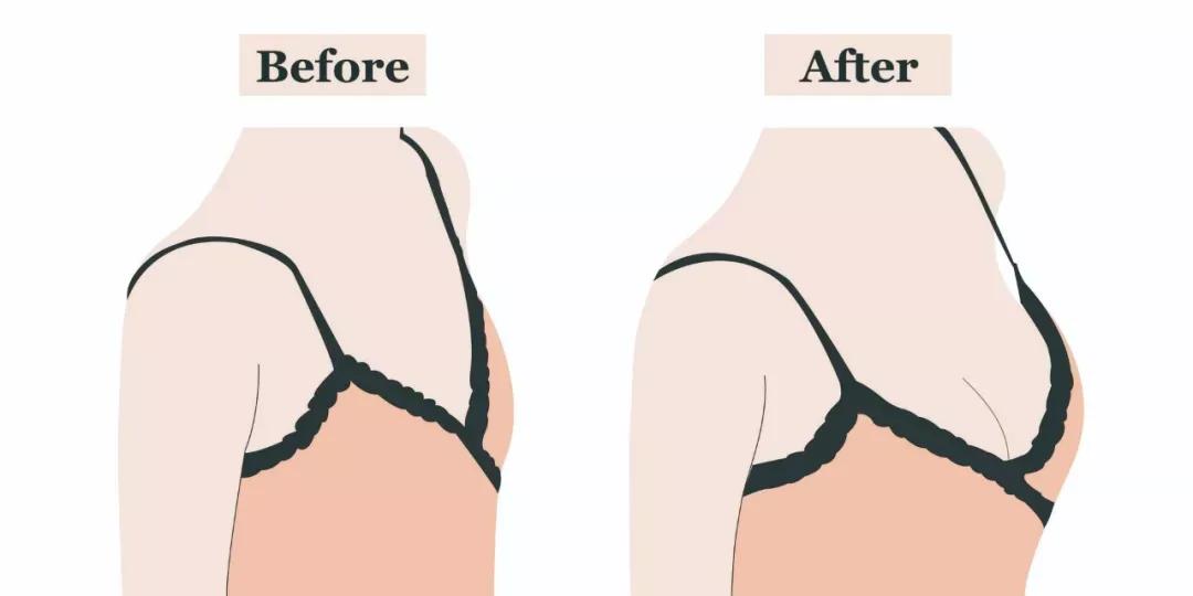 隆胸做多大比较合适,怎么样的隆胸才算完美