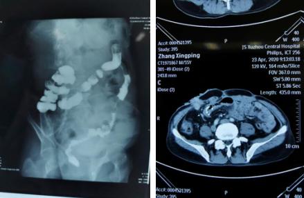 小肠堆积粪便,小肠有积粪用开塞露可以排便吗
