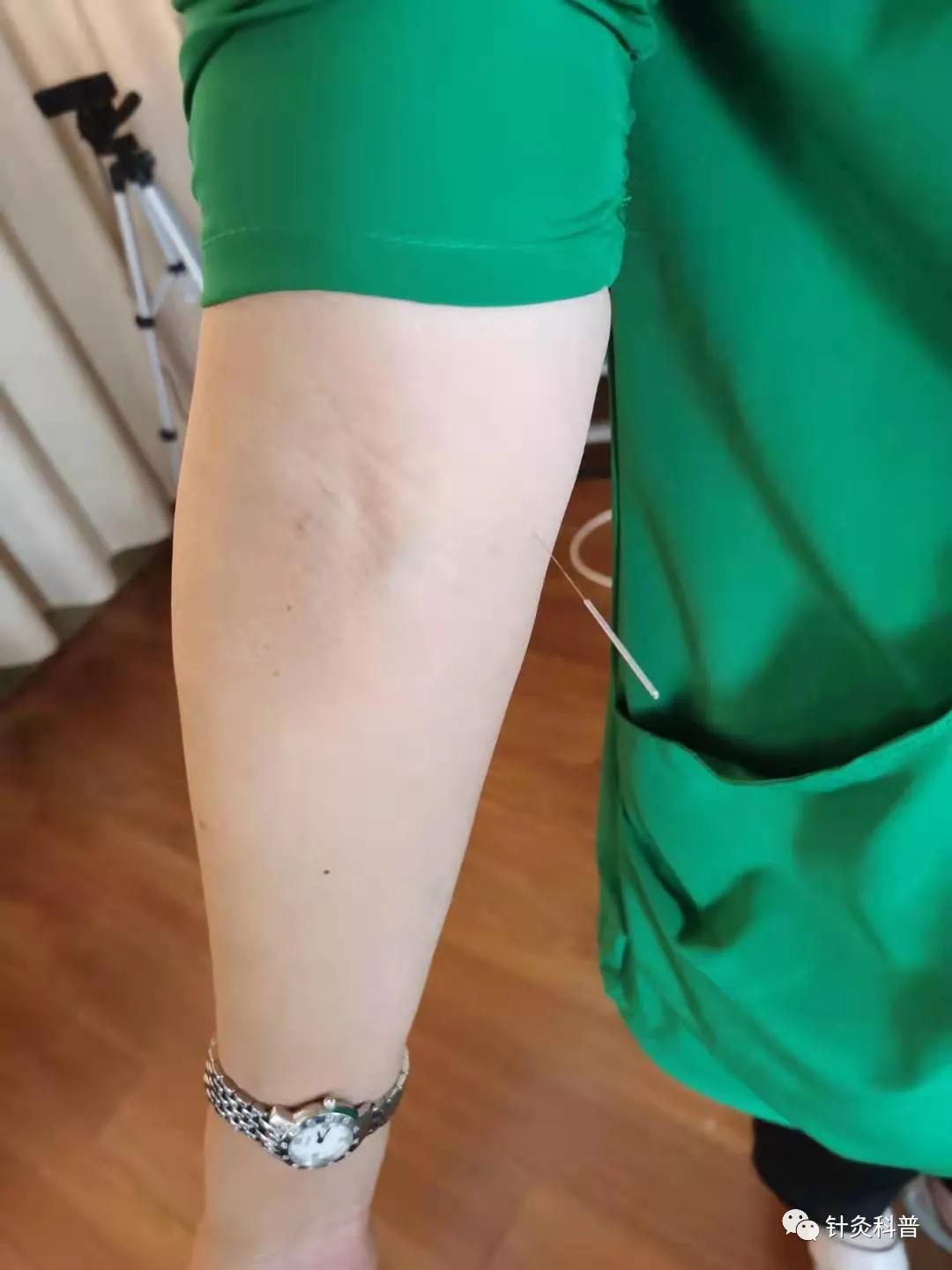 针灸治疗常见疾病方法,伤寒杂病论和针灸