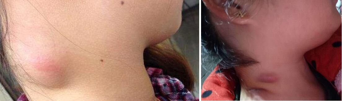 颈部淋巴结肿大要手术切除吗,颈部淋巴结肿大必须切除吗