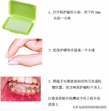 牙齿矫正戴牙套口腔溃疡了怎么办,牙齿矫正过程经常口腔溃疡怎么办