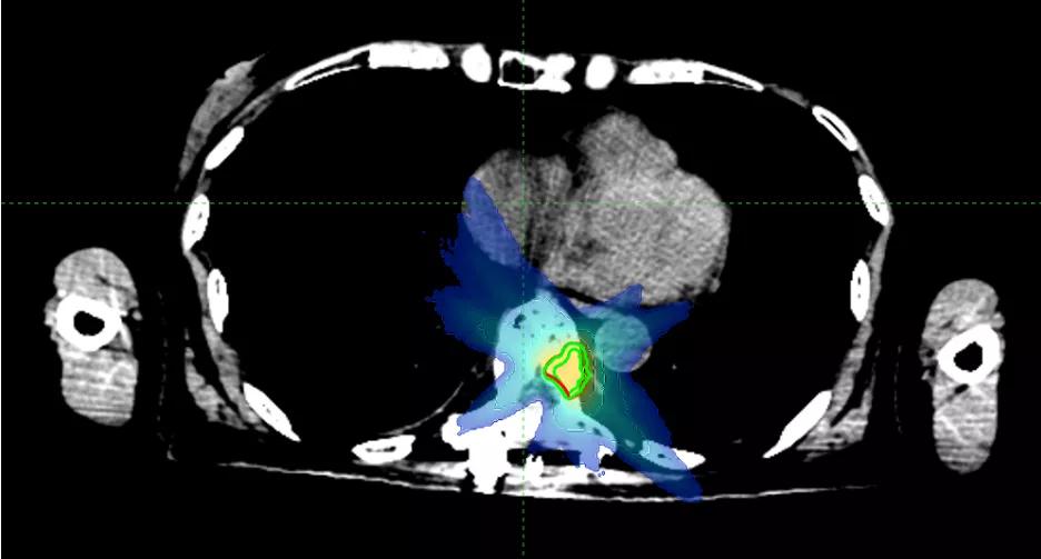 华东首秀!M6型射波刀落户国科大肿瘤医院