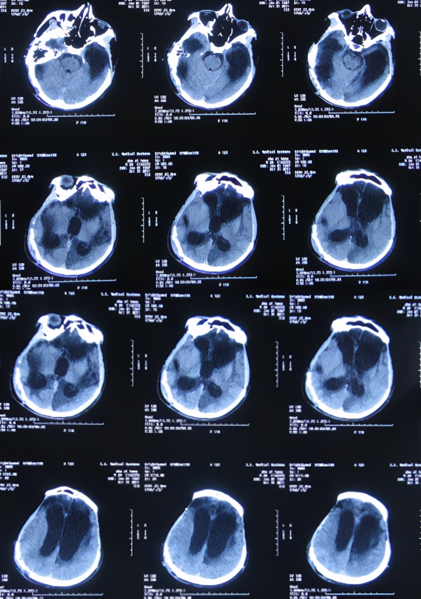 脑受伤开颅手术昏迷,开颅手术后20天发生脑积水引流