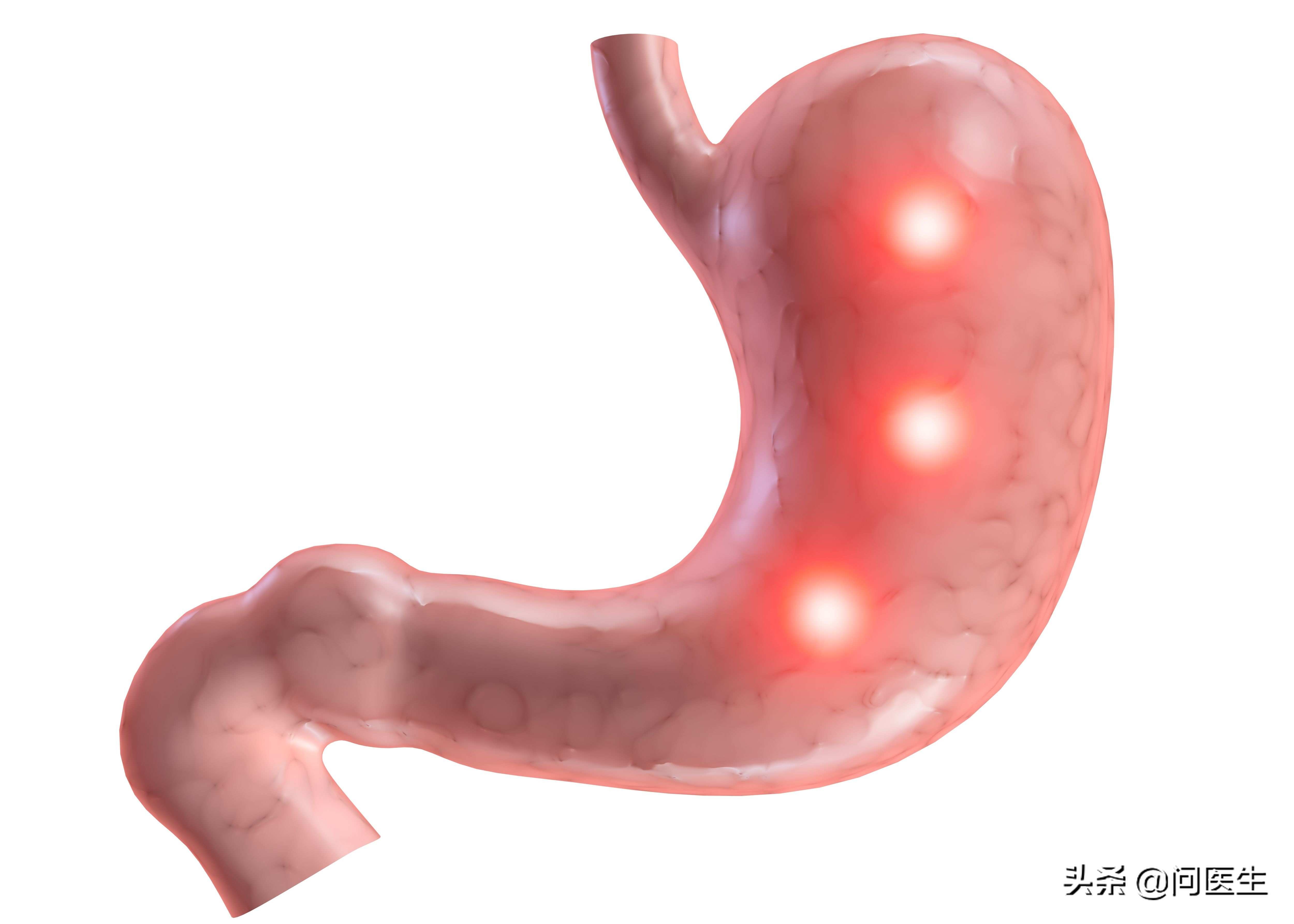 胃部有这3种情况长期不治疗，警惕胃炎变胃癌！请及时做胃镜检查