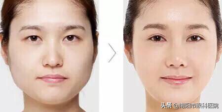 南阳市眼部整形,南阳整形双眼皮哪家医院好