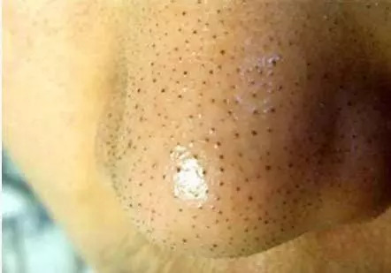 用手挤黑头小心变成草莓鼻，每天用这两样东西搓，黑头很快消失