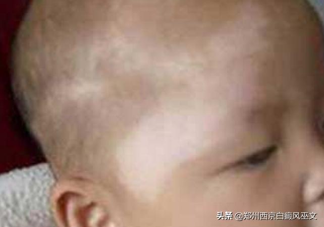 孩子患了白癜风父母应该如何应对,一岁小孩遗传白癜风发病咋办
