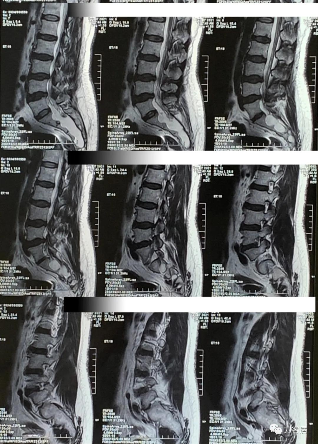 左下肢疼痛病历,门诊腹痛病历