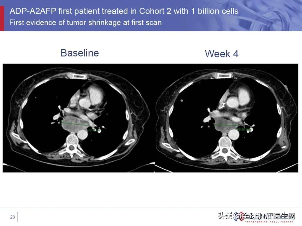 赶超CAR-T!新型T细胞免疫疗法TCR-T大战实体瘤