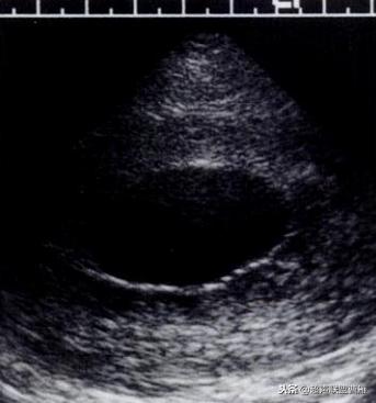 内见卵黄囊,卵黄囊肿瘤