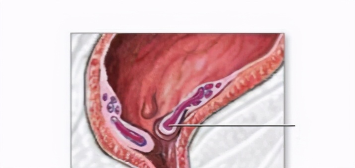 做了痔疮手术肿一直消不下去,痔疮手术后腿动不了是什么原因
