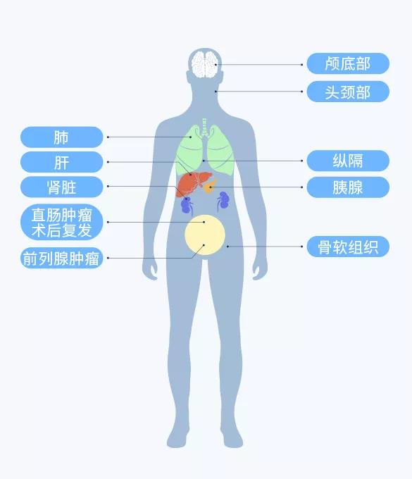 质子治疗癌症的利器,质子治癌细胞靠谱吗