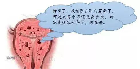 微创治疗子宫腺肌症，副作用大，还容易复发