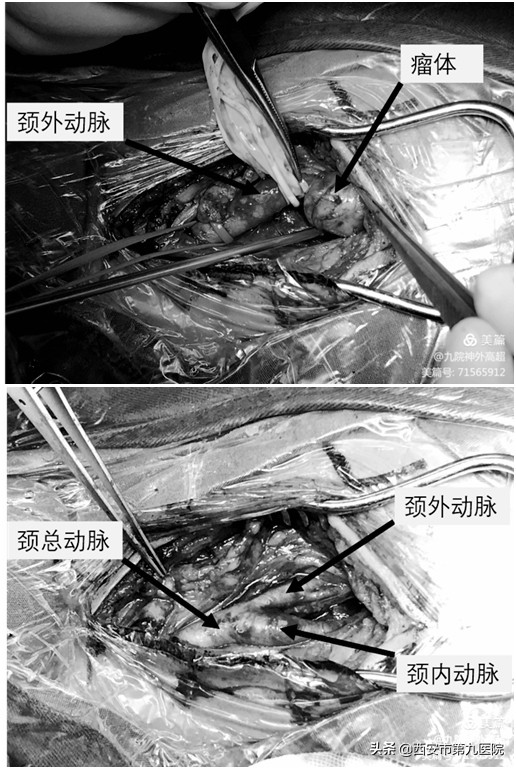 脖子上长一个神经瘤需要手术吗,颈动脉上有个凸起疑是动脉瘤