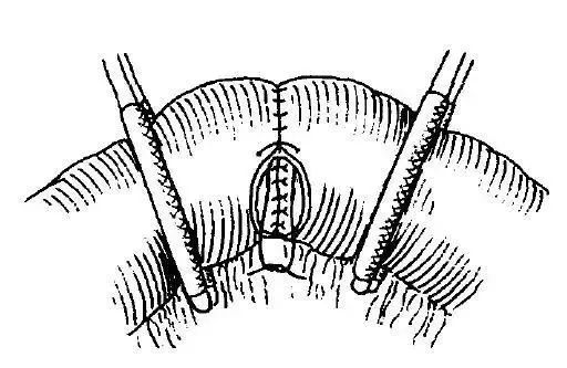 外科8种缝合方法图解,外科基本缝合方法实验报告