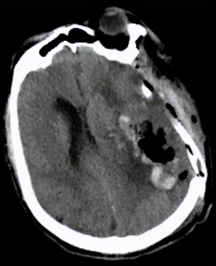 高血压脑出血开颅手术多久清醒,高血压脑出血昏迷要尽快手术吗