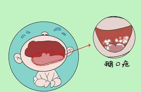 宝宝舌头上有白泡可以用针挑吗,婴儿嘴里的小白点可以用针戳掉吗